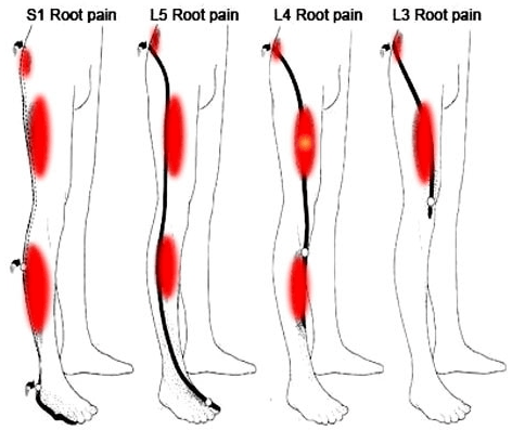 Symptoms of sciatica pain