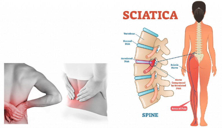 how to relief from scitica pain